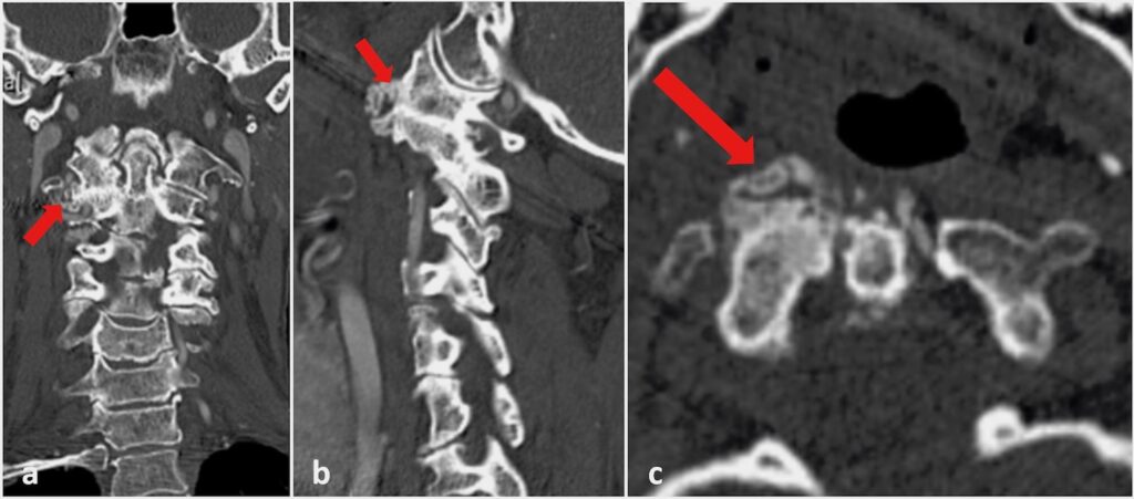 Thoracic Spine